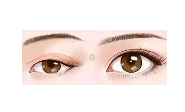 徐州二院哪個(gè)醫(yī)生做雙眼皮好？陶常波、張愛君等實(shí)力過硬