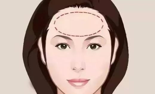 喬雅登雅致適合做哪些部位？皺紋拜拜|玻尿酸去抬頭紋案例附上