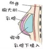 隆胸5.png 隆胸5.png