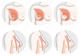 隆胸9.png 隆胸9.png