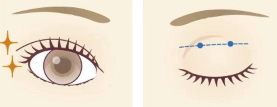 雙眼皮9.png 雙眼皮9.png