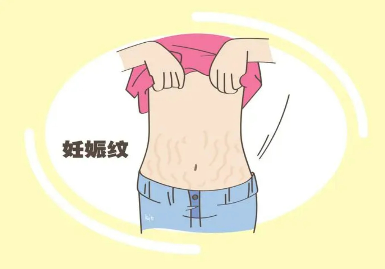 激光改良妊娠紋2.png 激光改良妊娠紋2.png